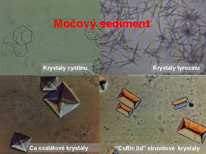 Močový sediment Krystaly cystinu Krystaly tyrosinu Ca oxalátové krystaly “Coffin lid” struvitové krystaly 