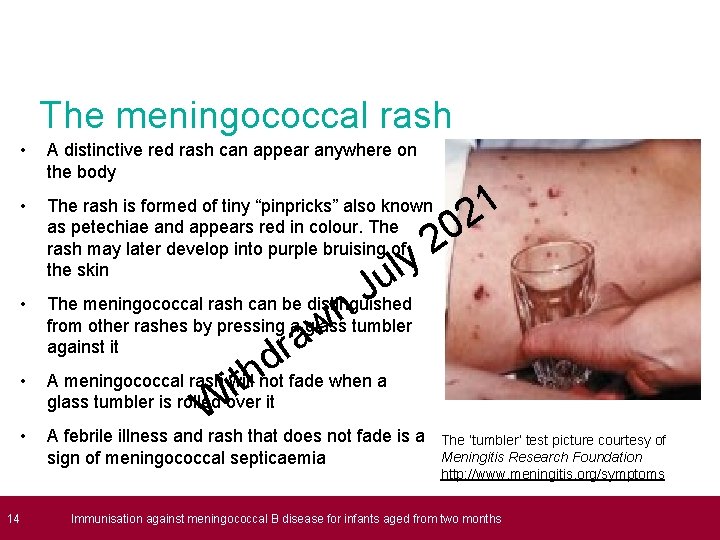 The meningococcal rash • A distinctive red rash can appear anywhere on the body