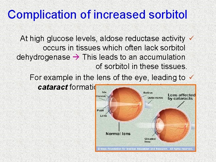 Complication of increased sorbitol At high glucose levels, aldose reductase activity ü occurs in
