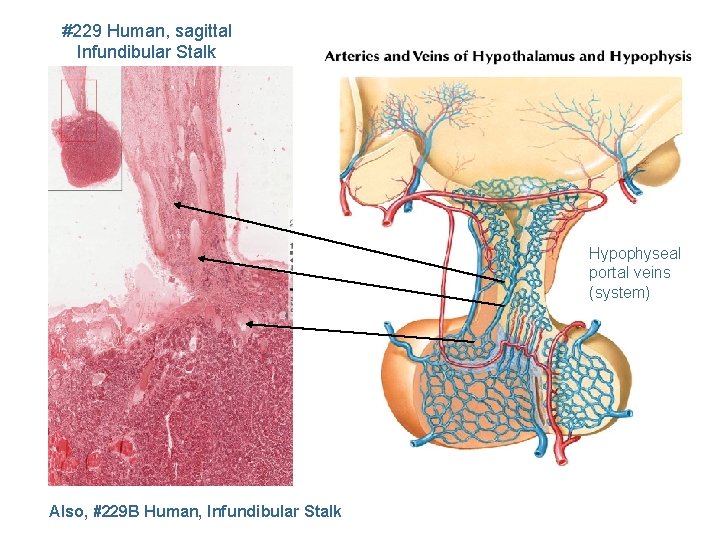 #229 Human, sagittal Infundibular Stalk Hypophyseal portal veins (system) Also, #229 B Human, Infundibular