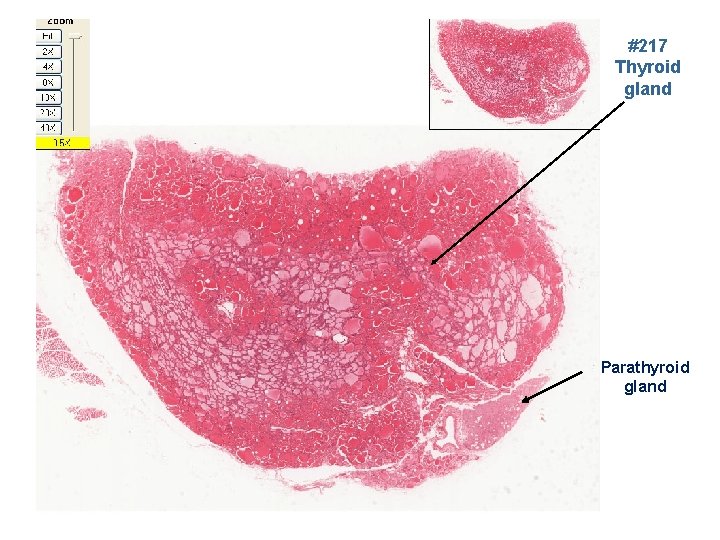 #217 Thyroid gland Parathyroid gland 