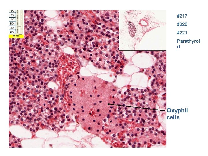 #217 #220 #221 Parathyroi d Oxyphil cells 