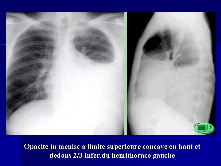 Opacite în menisc a limite superieure concave en haut et dedans 2/3 infer. du