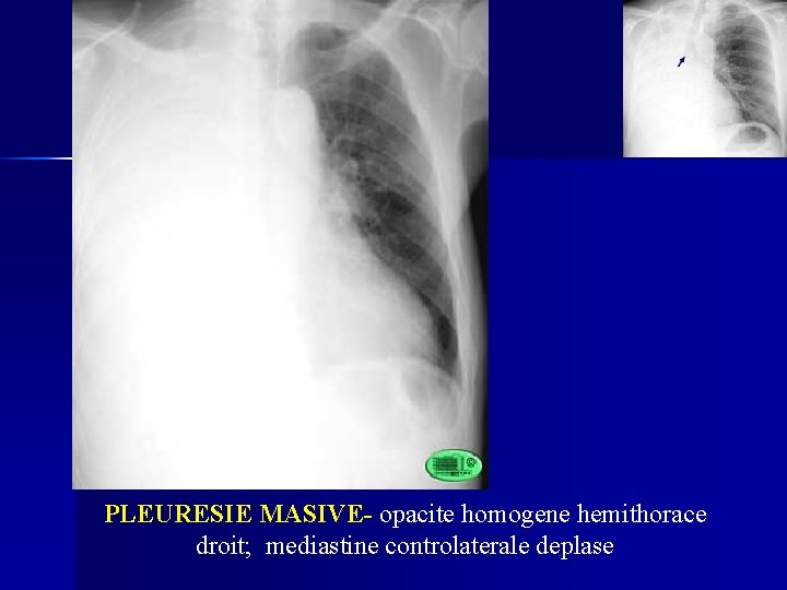 PLEURESIE MASIVE- opacite homogene hemithorace droit; mediastine controlaterale deplase 