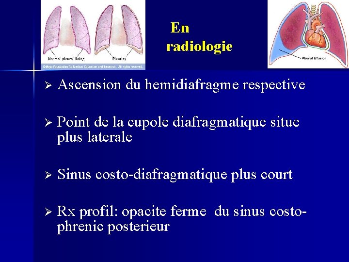 En radiologie Ø Ascension du hemidiafragme respective Ø Point de la cupole diafragmatique situe
