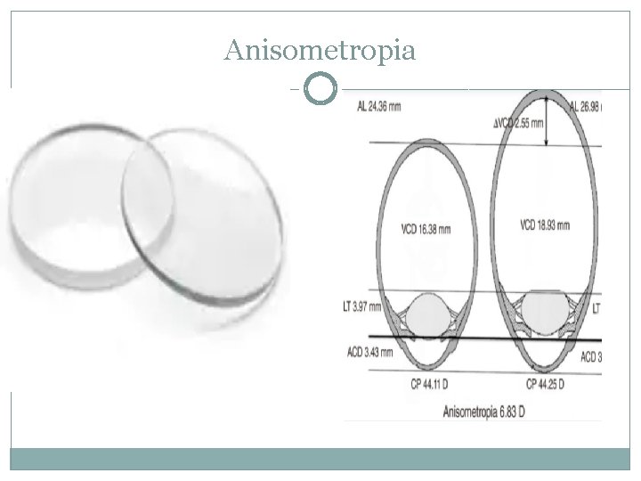 Anisometropia 