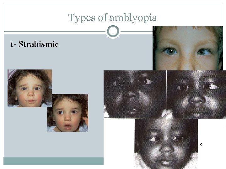 Types of amblyopia 1 - Strabismic 