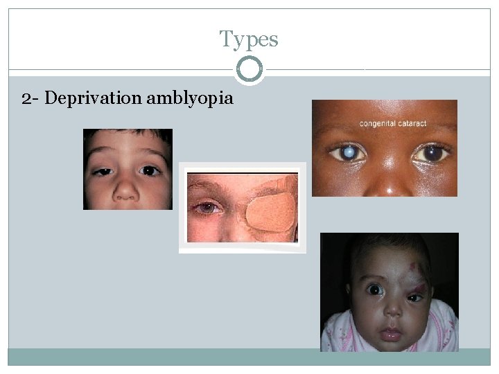 Types 2 - Deprivation amblyopia 