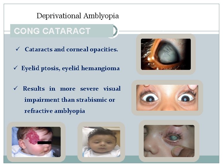 Deprivational Amblyopia CONG CATARACT ü Cataracts and corneal opacities. ü Eyelid ptosis, eyelid hemangioma