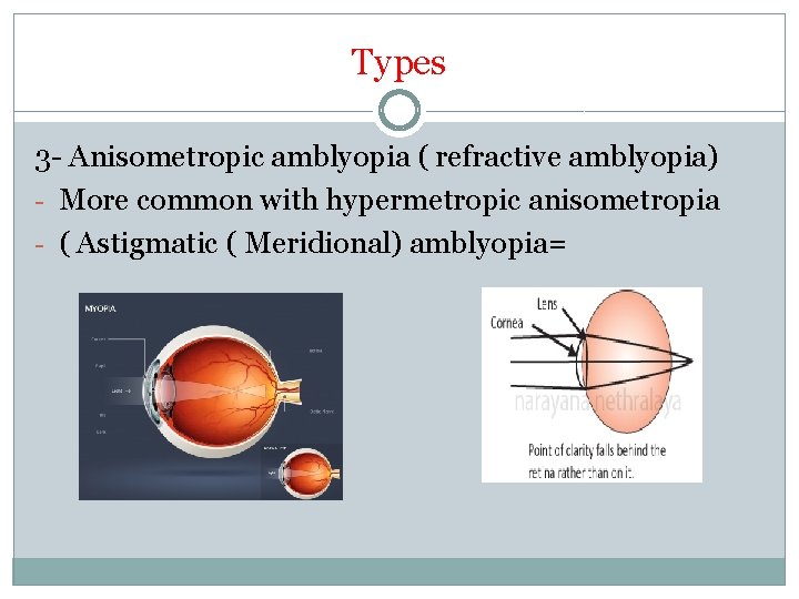 Types 3 - Anisometropic amblyopia ( refractive amblyopia) - More common with hypermetropic anisometropia