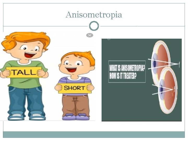 Anisometropia 
