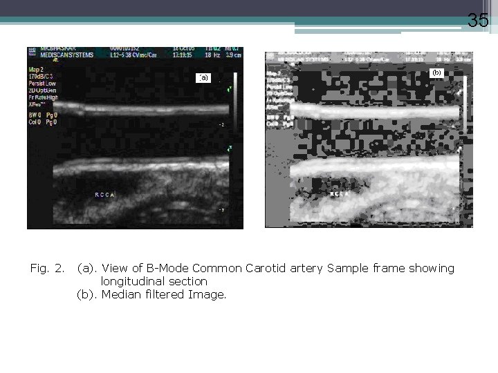 35 Fig. 2. (a). View of B-Mode Common Carotid artery Sample frame showing longitudinal