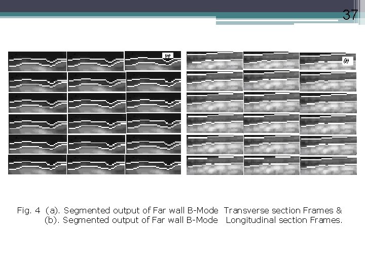 37 Fig. 4 (a). Segmented output of Far wall B-Mode Transverse section Frames &
