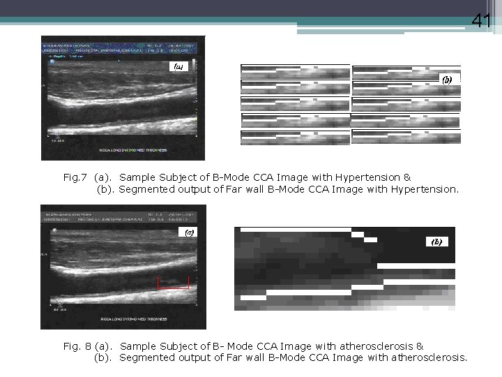 41 Fig. 7 (a). Sample Subject of B-Mode CCA Image with Hypertension & (b).
