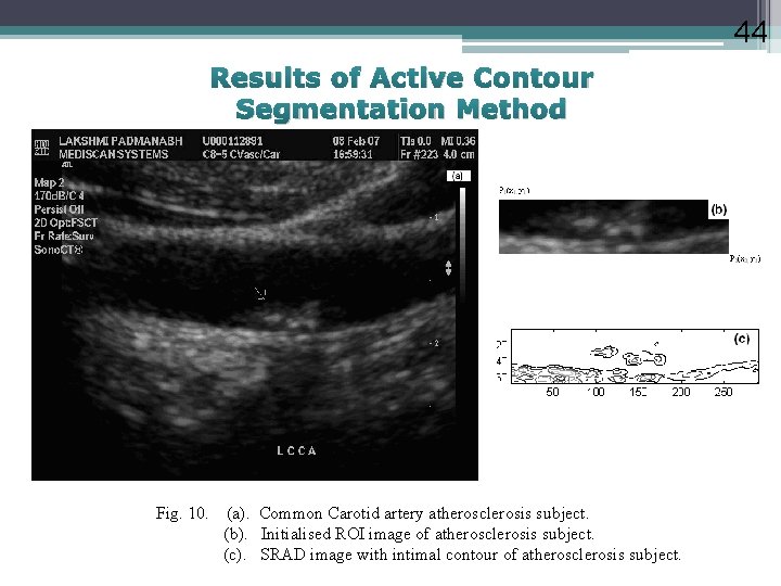 44 Results of Active Contour Segmentation Method Fig. 10. (a). Common Carotid artery atherosclerosis