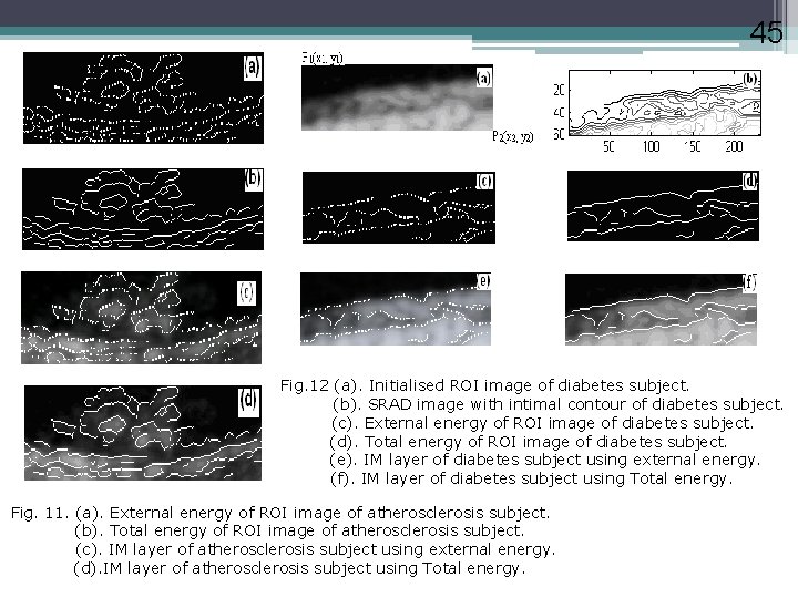 45 Fig. 12 (a). Initialised ROI image of diabetes subject. (b). SRAD image with