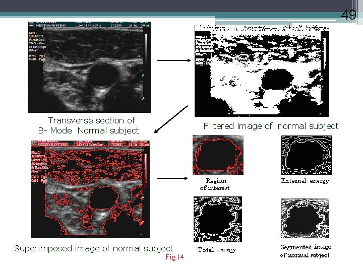 49 Transverse section of B- Mode Normal subject Filtered image of normal subject Superimposed