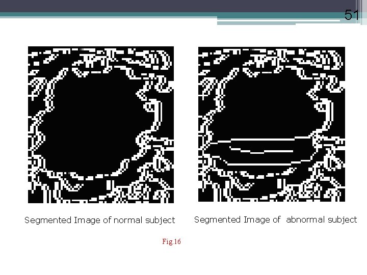 51 Segmented Image of normal subject Fig. 16 Segmented Image of abnormal subject 
