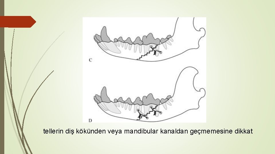 tellerin diş kökünden veya mandibular kanaldan geçmemesine dikkat 