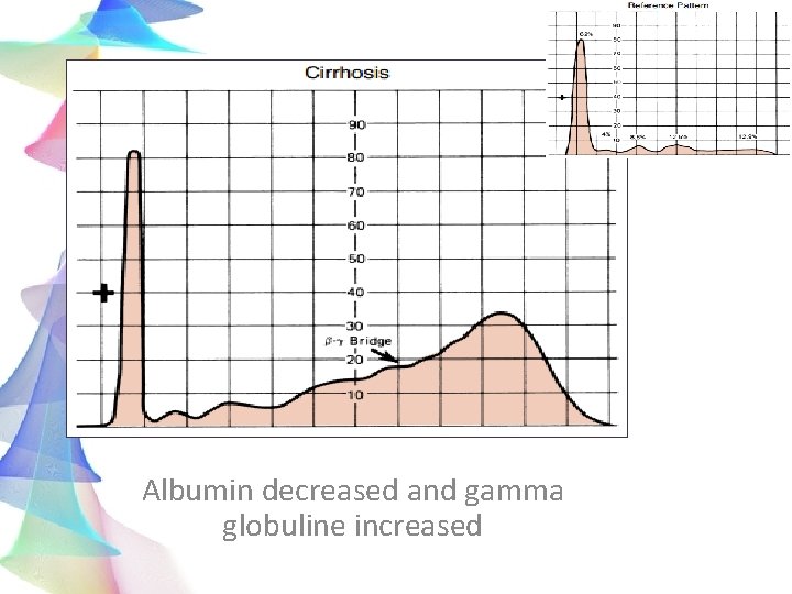 Albumin decreased and gamma globuline increased 