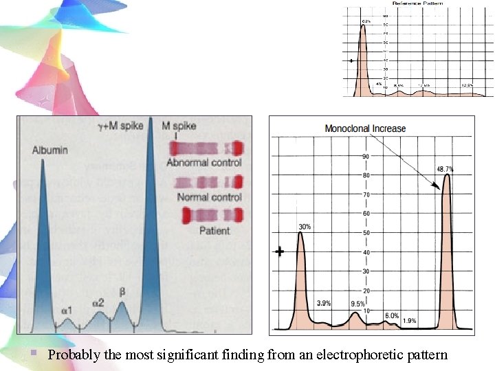 § Probably the most significant finding from an electrophoretic pattern 