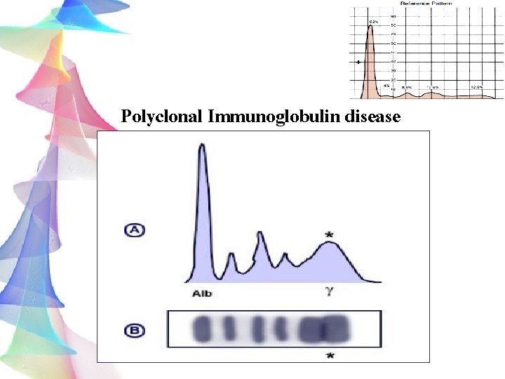 Polyclonal Immunoglobulin disease 