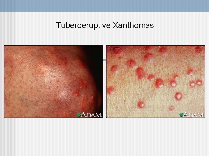 Tuberoeruptive Xanthomas 