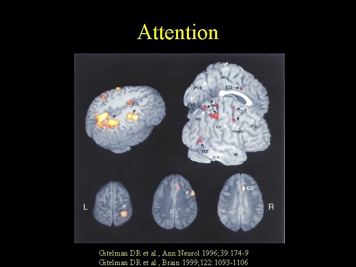 Attention Gitelman DR et al. , Ann Neurol 1996; 39: 174 -9 Gitelman DR