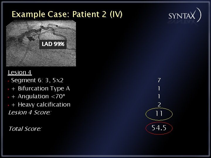 Example Case: Patient 2 (IV) LAD 99% Lesion 4 Segment 6: 3, 5 x