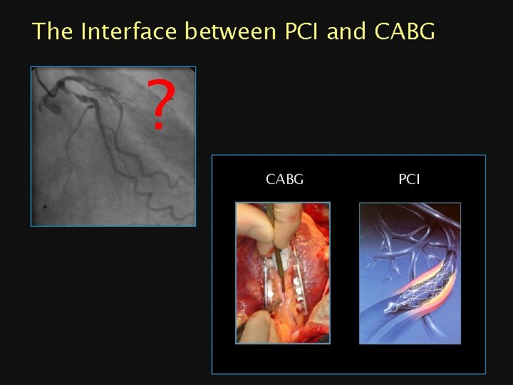 The Interface between PCI and CABG ? CABG PCI 