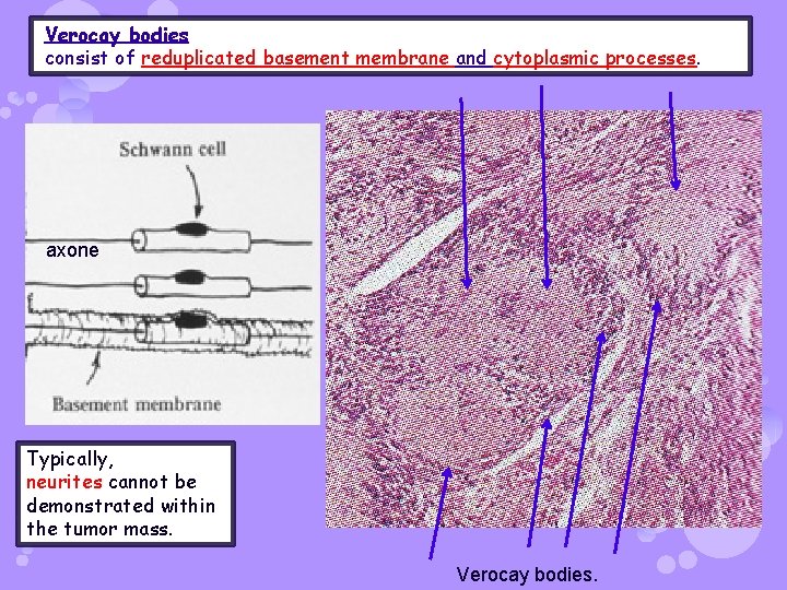 Verocay bodies consist of reduplicated basement membrane and cytoplasmic processes. axone Typically, neurites cannot
