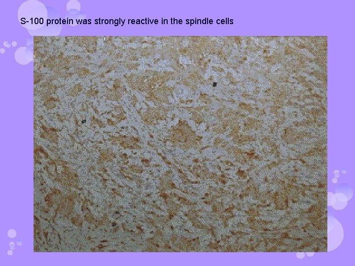 S-100 protein was strongly reactive in the spindle cells 