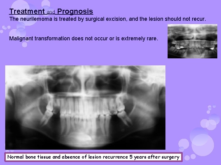 Treatment and Prognosis The neurilemoma is treated by surgical excision, and the lesion should