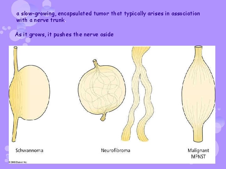 a slow-growing, encapsulated tumor that typically arises in association with a nerve trunk. As