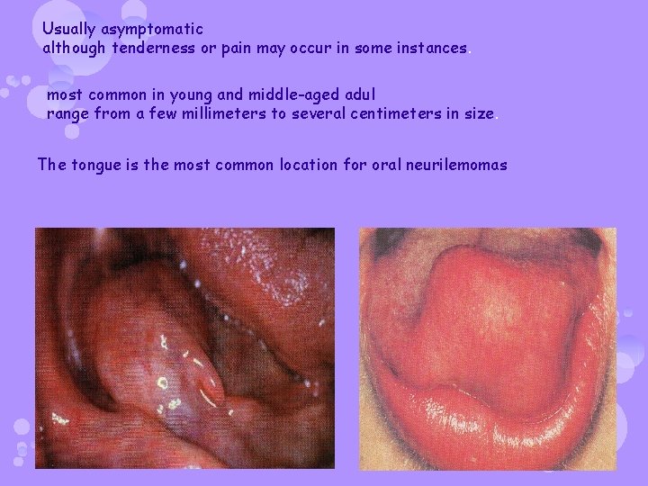 Usually asymptomatic although tenderness or pain may occur in some instances. most common in