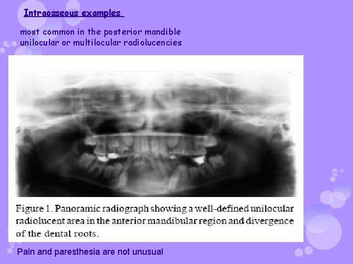 Intraosseous examples most common in the posterior mandible unilocular or multilocular radiolucencies Pain and