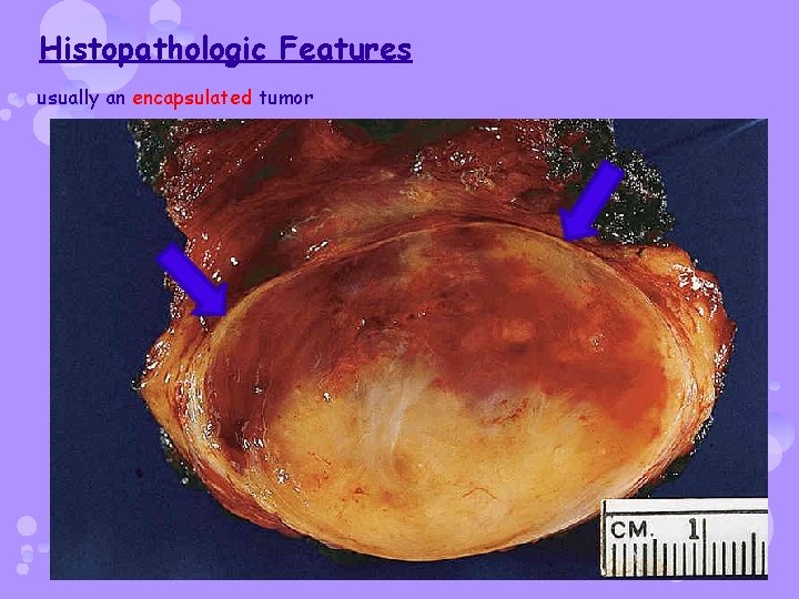 Histopathologic Features usually an encapsulated tumor 