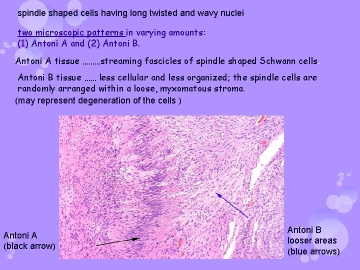 spindle shaped cells having long twisted and wavy nuclei two microscopic patterns in varying