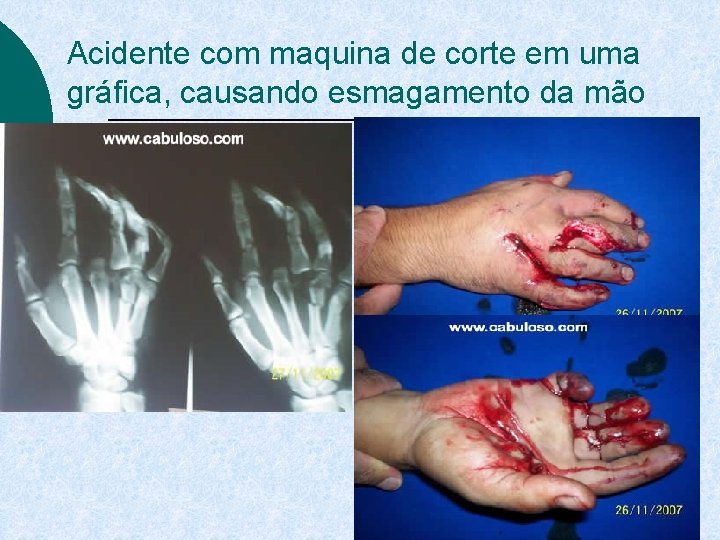 Acidente com maquina de corte em uma gráfica, causando esmagamento da mão 