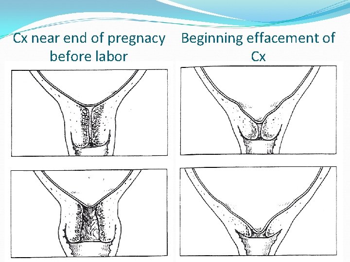 Cx near end of pregnacy Beginning effacement of before labor Cx 