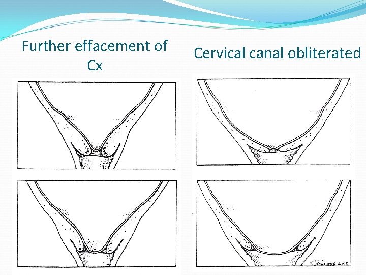 Further effacement of Cx Cervical canal obliterated 