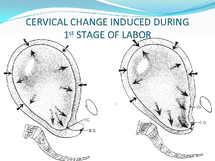 CERVICAL CHANGE INDUCED DURING 1 st STAGE OF LABOR 