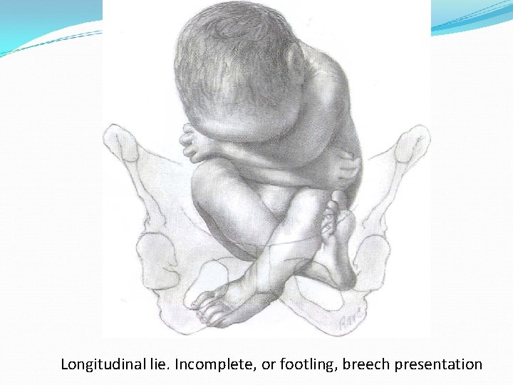 Longitudinal lie. Incomplete, or footling, breech presentation 