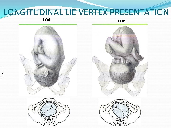 LONGITUDINAL LIE VERTEX PRESENTATION LOA ~ ' t J LOP 