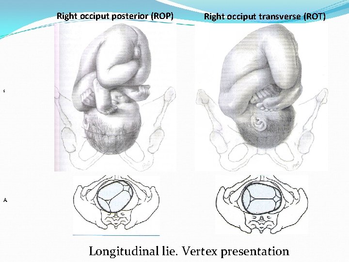 Right occiput posterior (ROP) Right occiput transverse (ROT) s A Longitudinal lie. Vertex presentation