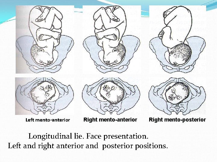 Left mento-anterior Right mento-posterior Longitudinal lie. Face presentation. Left and right anterior and posterior