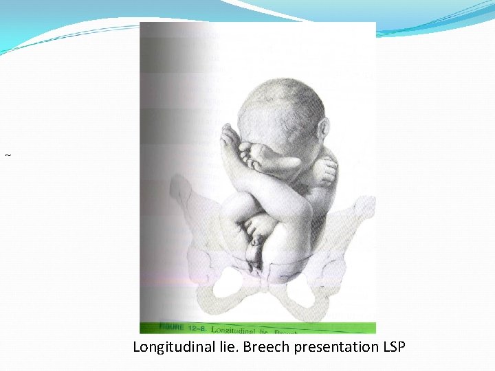 ~ Longitudinal lie. Breech presentation LSP 