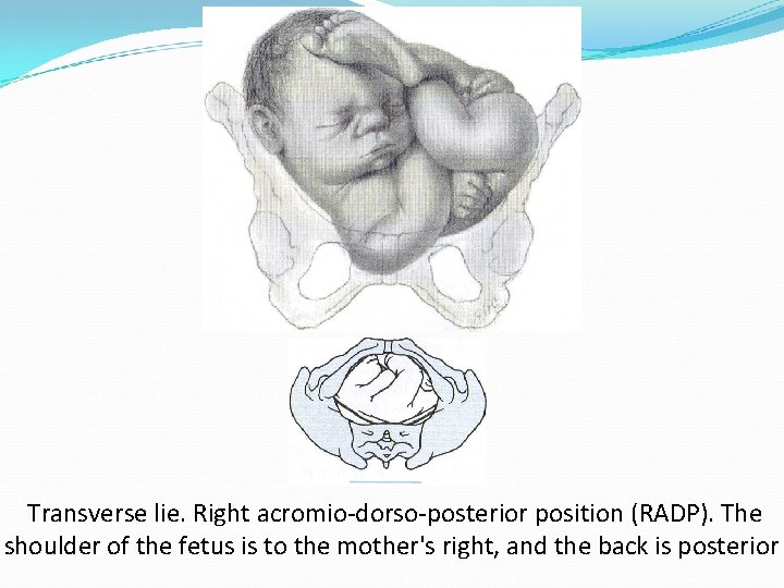 Transverse lie. Right acromio-dorso-posterior position (RADP). The shoulder of the fetus is to the