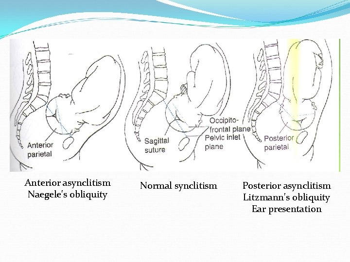 Anterior asynclitism Naegele's obliquity Normal synclitism Posterior asynclitism Litzmann's obliquity Ear presentation 