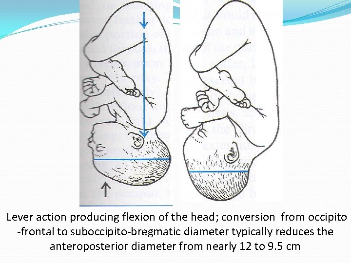 Lever action producing flexion of the head; conversion from occipito -frontal to suboccipito-bregmatic diameter